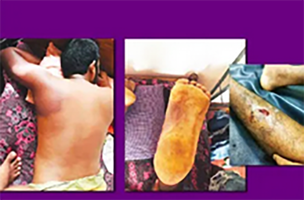 පොලීසියේදී ඇට කැඩෙන තුරු පහර කෑ දිල්ශාන්ගේ කතාව