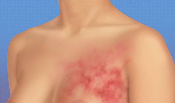 Study Reveals Inadequate Breast Cancer Surveillance in Sri Lanka